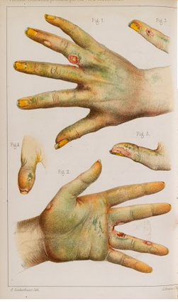 effects-of-arsenic-poisoning-3